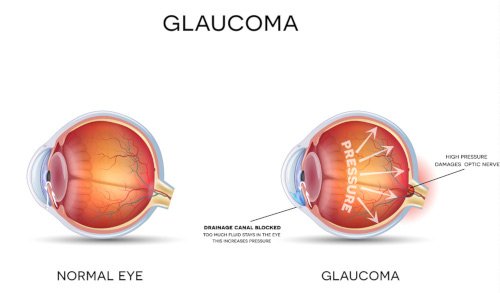 Cataract